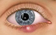 潍坊眼镜学校分享如何预防麦粒肿