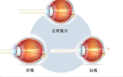 济南验光学校分享近视会引起哪些眼病