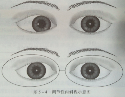 潍坊眼镜学校分享调节性内斜视