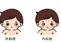 济南验光师分享知觉性斜视的检查和诊断