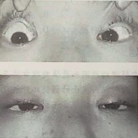 泰安眼镜学校分享眼睛重症肌无力