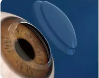 潍坊验光师分享角膜接触镜的基础特性